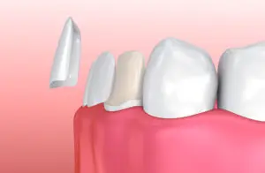 veneers Albany