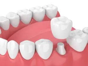 porcelain crowns Albany