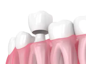 porcelain crowns Albany