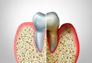 gum treatment Albany NY
