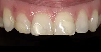 DeSanti Smile Gallery 11 Before