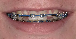DeSanti Smile Gallery 12 Before