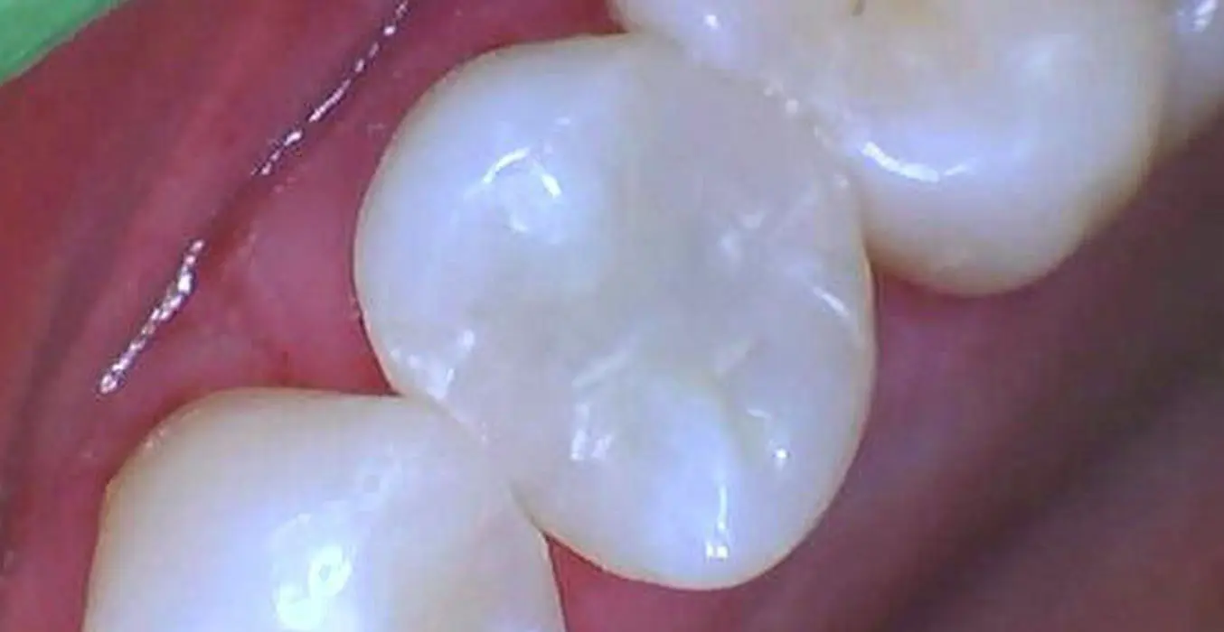 enamel tooth filling