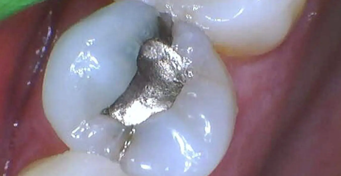 metal tooth filling