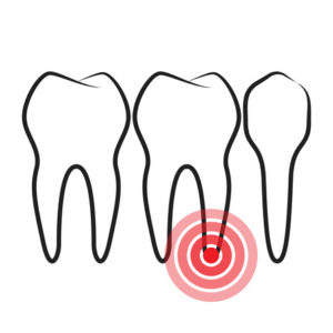 root canal therapy Albany