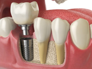 dental implants Albany