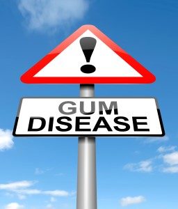Symptoms Of Gum Disease