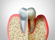 gum treatment Albany NY