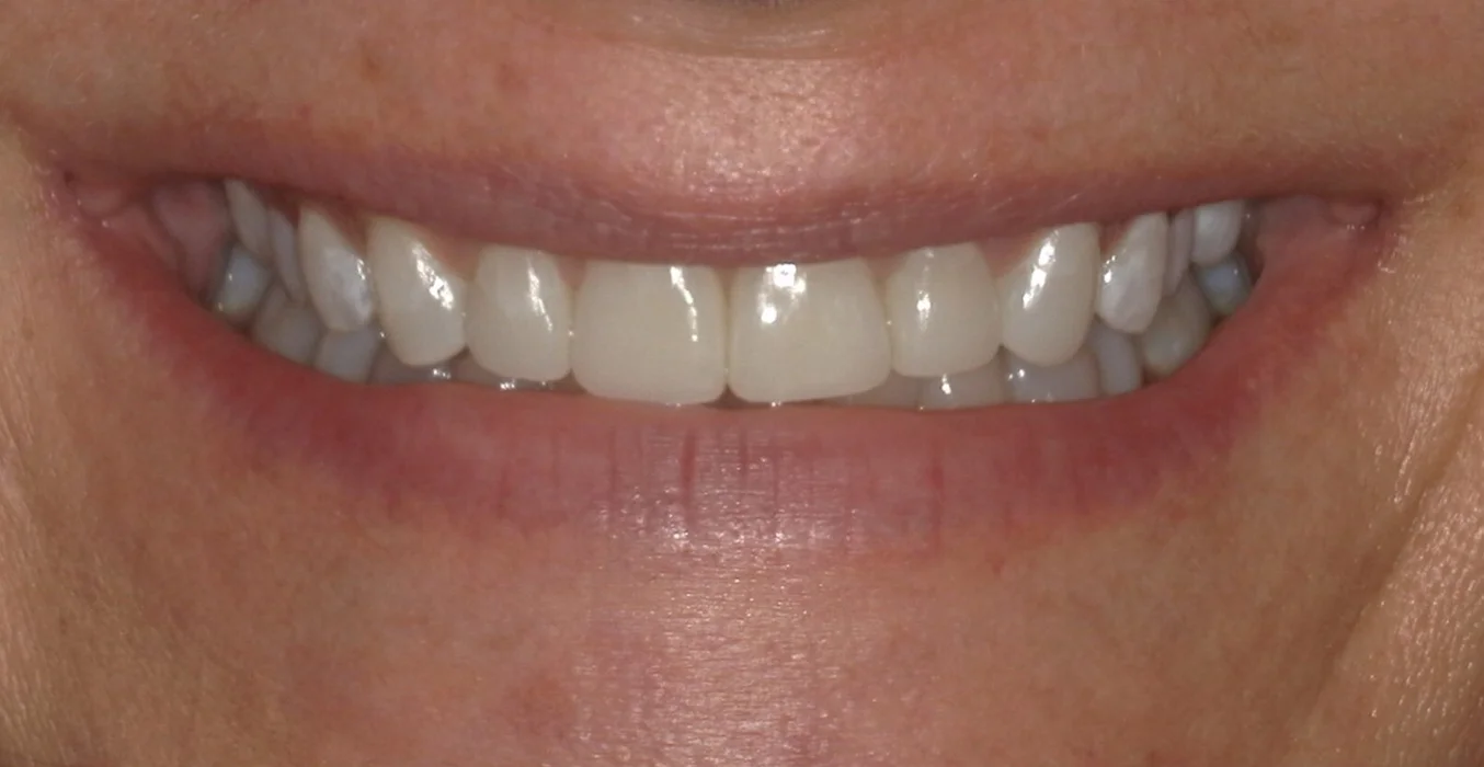 DeSanti Smile Gallery 16 After