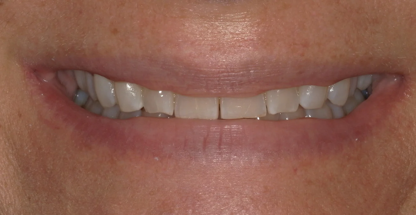 DeSanti Smile Gallery 16 Before