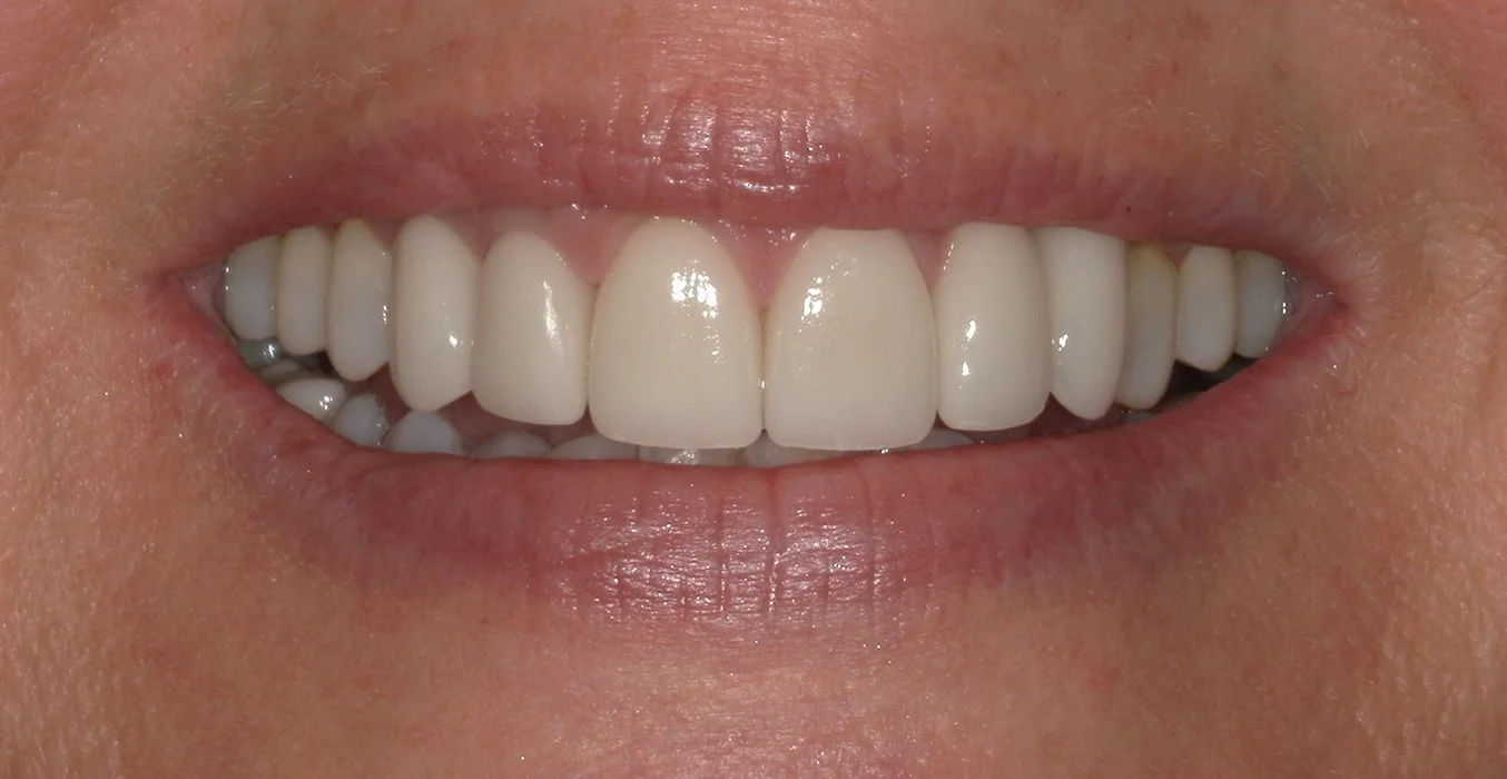 DeSanti Smile Gallery 17 After